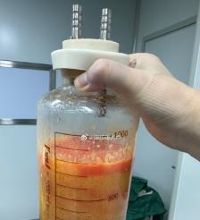 普洱水动力吸脂手术要做多久？